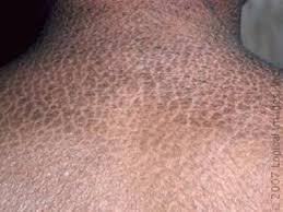 Da vẩy cá - Hình ảnh minh họa